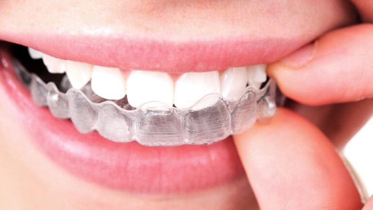 invisalign apparecchio invisibile centro odontoiatrico pitino modica ragusa